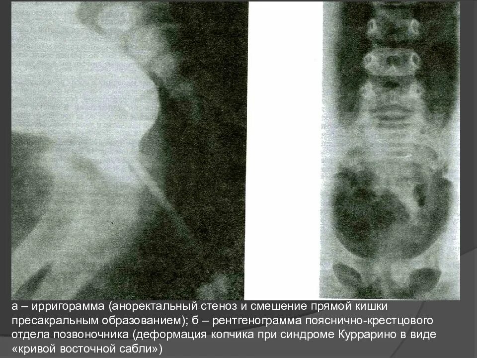Спинномозговая грыжа