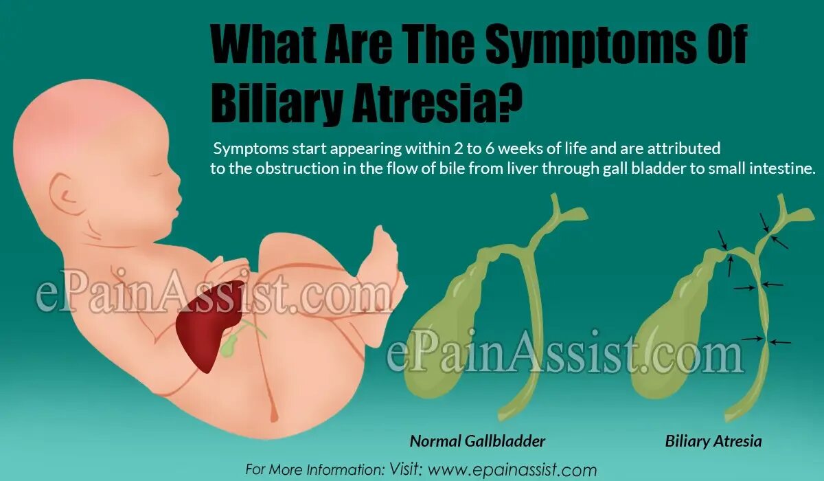 Желчный пузырь у новорожденного. Атрезия желчевыводящих путей. Атрезия желчевыводящих путей у новорожденных.