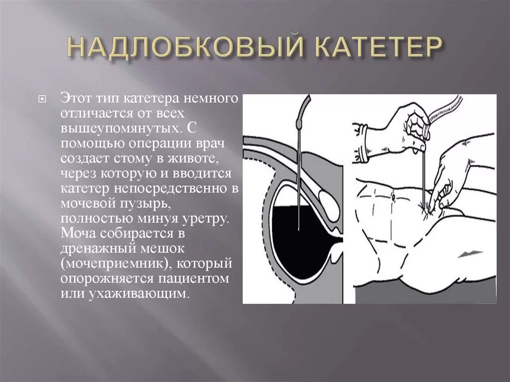 Дренирование мочевого пузыря цистостомой. Цистостомия мочевого пузыря техника выполнения. Троакарная цистостомия мочевого пузыря. Цистостома мочевого пузыря показания. Промывают мочевой пузырь у мужчин