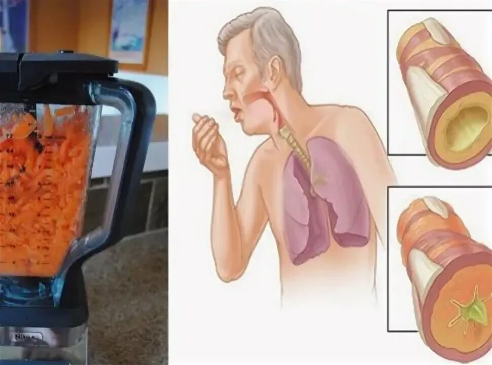 Удаление мокроты из легких