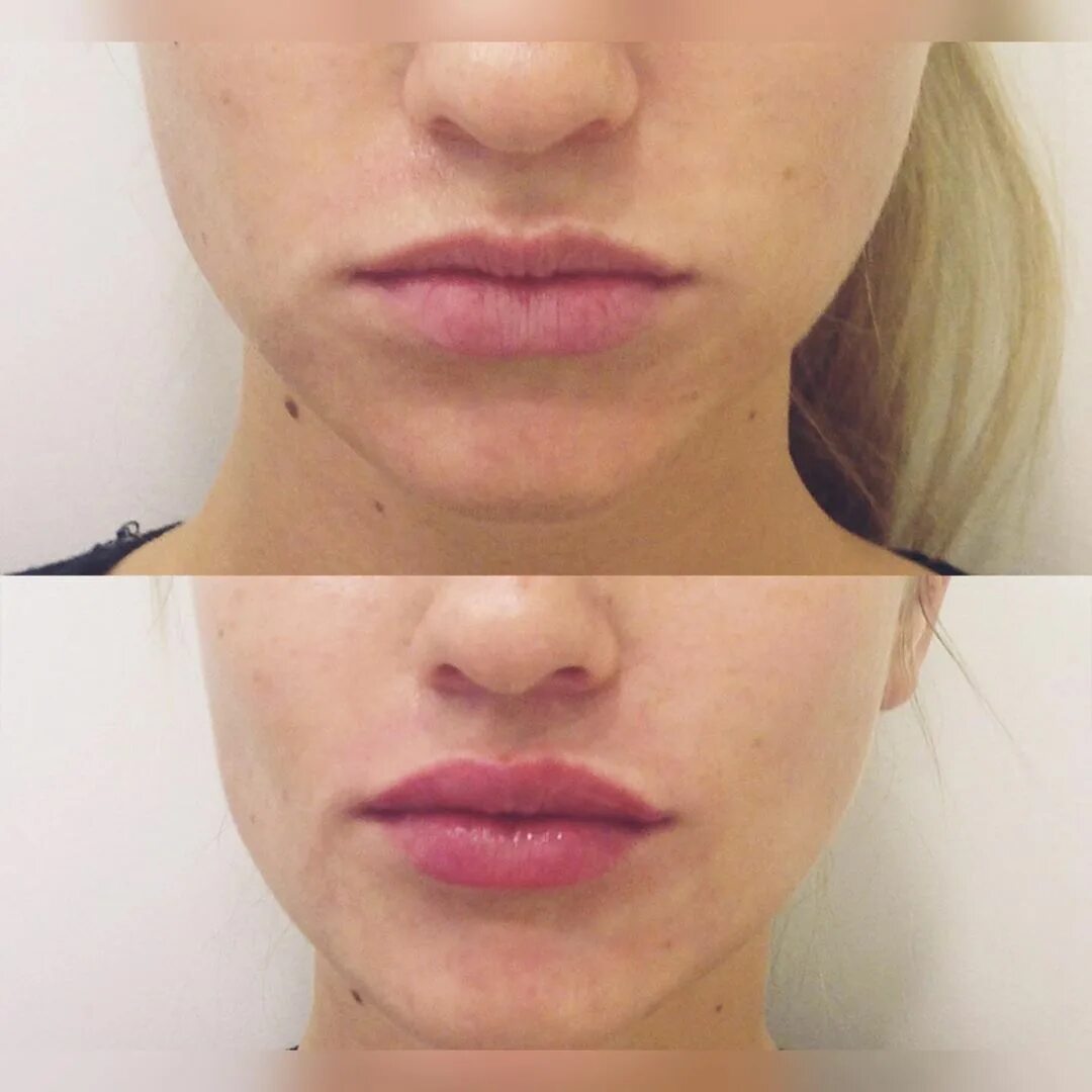 Хейлопластика кессельринг. Красивые губы контурная пластика. Хейлопластика кессельринг. 5 мл. Контурная пластика губ до и после.