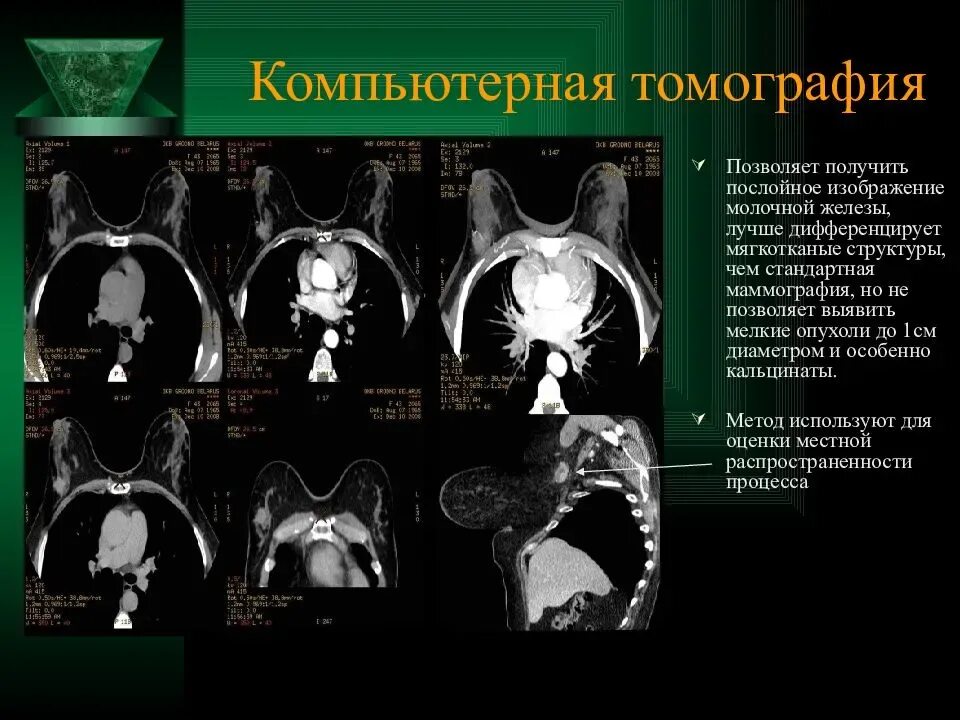 Можно ли кт. Компьютерная томография груди. Компьютерная томография (кт). Молочной железы.