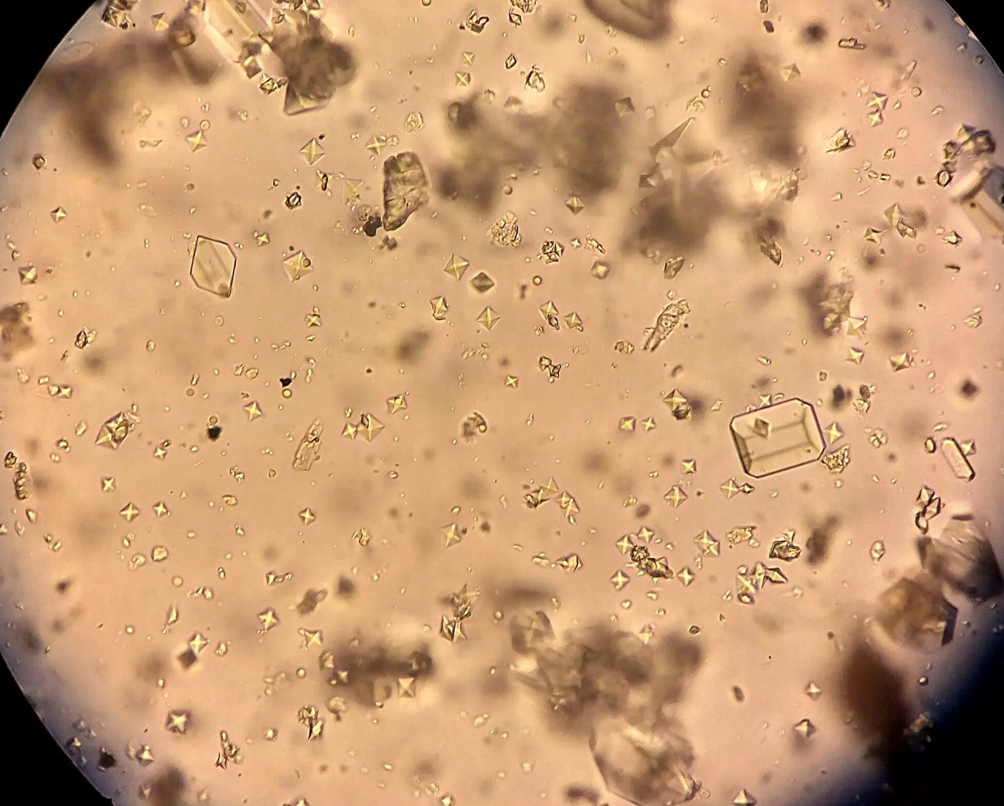 Струвиты микроскопия. Бактерии в моче под микроскопом. Микроскопия мочи бактерии. Моча под микроскопом.