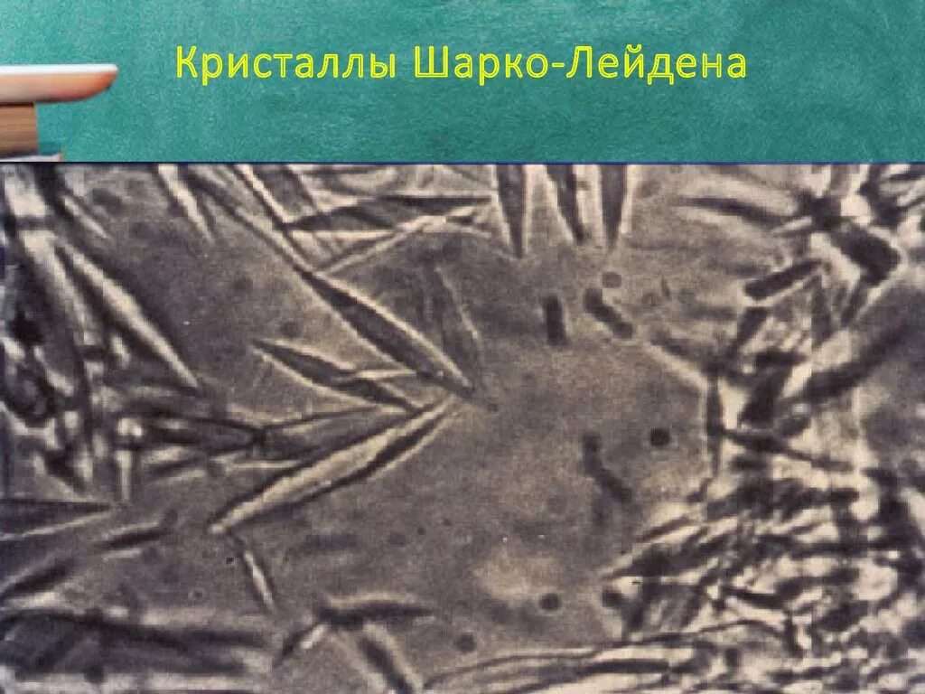 Куршмана кристаллы шарко лейдена. Кристаллы Шарко Лейдена. Кристаллы Шарко-Лейдена в Кале. Кристаллы Шарко Лейдена в Кале микроскопия. Клетки Шарко Лейдена.