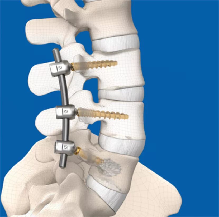 Операция на позвоночник как вставать. Транспедикулярная фиксация l5-s1. Транспедикулярный остеосинтез. Операция транспедикулярная фиксация позвоночника. Stryker Xia 3 система транспедикулярной фиксации.