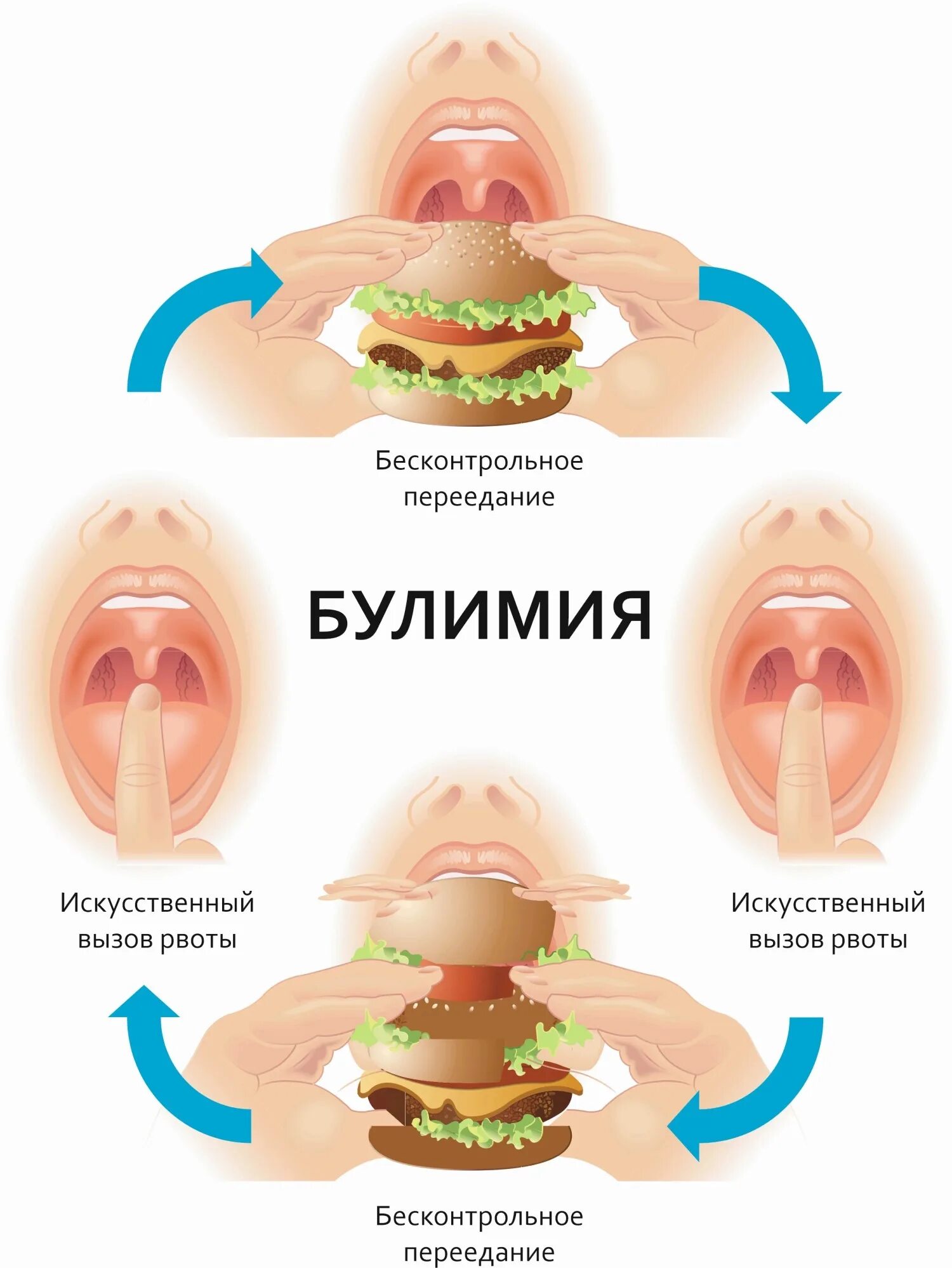 Как вылечить булимию