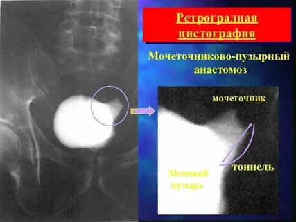 Операция шейки мочевого пузыря