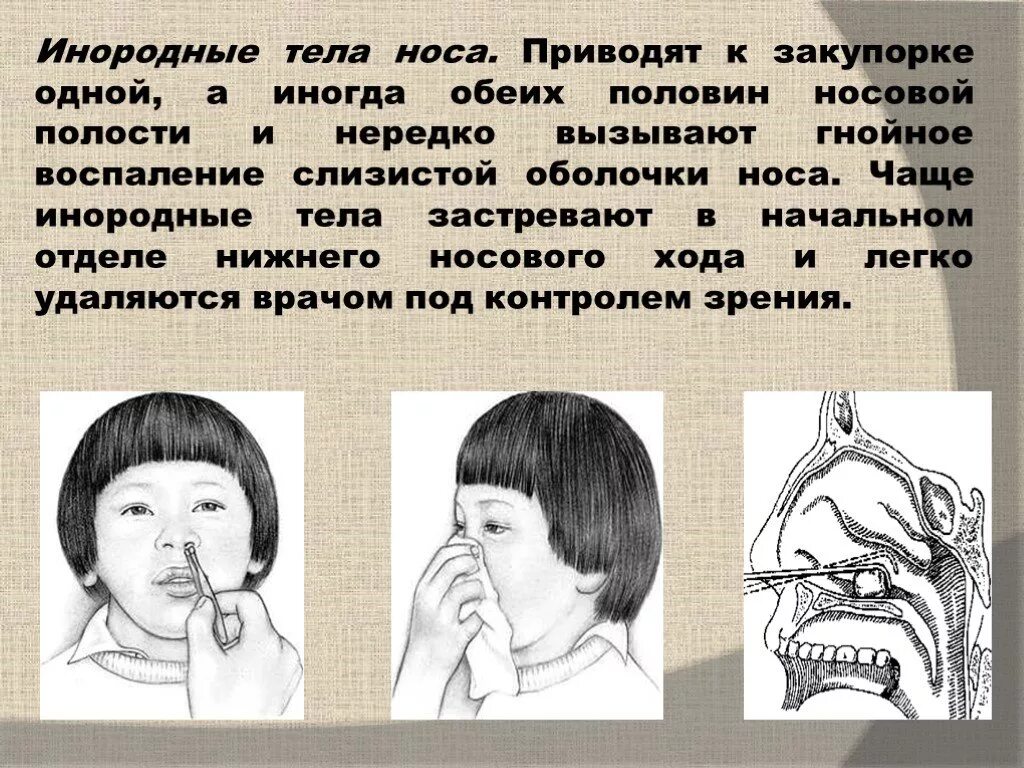 Что значит совать нос. Инородное тело в носу у ребенка. инородные тела полости носа. инородное тело в носовой полости. инородное тело в носу симптомы.