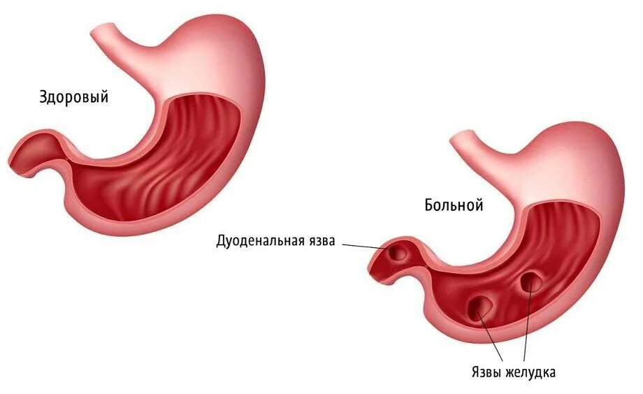 Язвенной болезни желудка язвенная болезнь желудка. Язвенная болезнь желудка и 12 перстной кишки. Язвенная болезнь желудка язвенная болезнь 12 перстной кишки. Язвенная болезнь 12 перстной кишки. Кофе при язве желудка