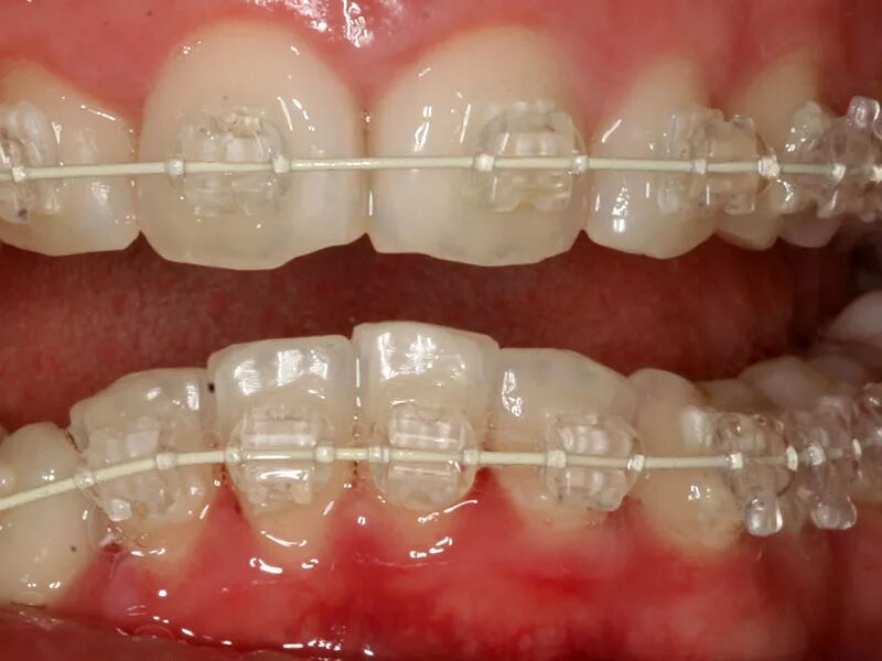 брекеты сапфировые прозрачные. сапфировое невидимые брекеты. брекеты невидимые прозрачные. брекеты carriere slx 3d. керамические невидимые брекеты.