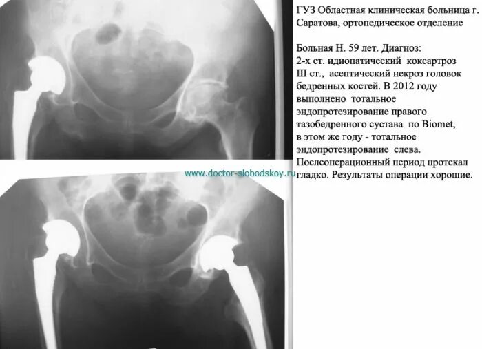 Коксартроз тазобедренного сустава 3. Идиопатический коксартроз. коксартроз 3 ст рентген описание. идиопатический коксартроз 3 степени. коксартроз кт.