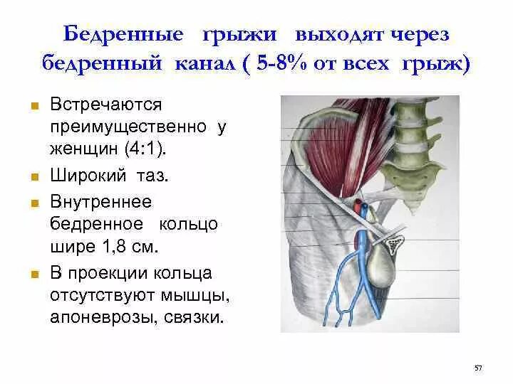 Ущемленная бедренная грыжа. Бедренные грыжи топографическая анатомия. Анатомические предпосылки бедренных грыж. Бедренный грыжа стенки топографическая анатомия. Стенки глубокого кольца бедренного канала.