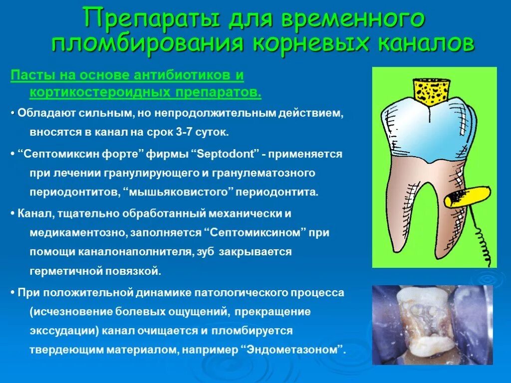 Временное пломбирование корневых каналов. Препараты для временного пломбирования корневых каналов. Временное пломбирование корневых каналов презентация. Группы препаратов для временной обтурации корневого канала. Препараты и методы медикаментозной обработки корневого канала.