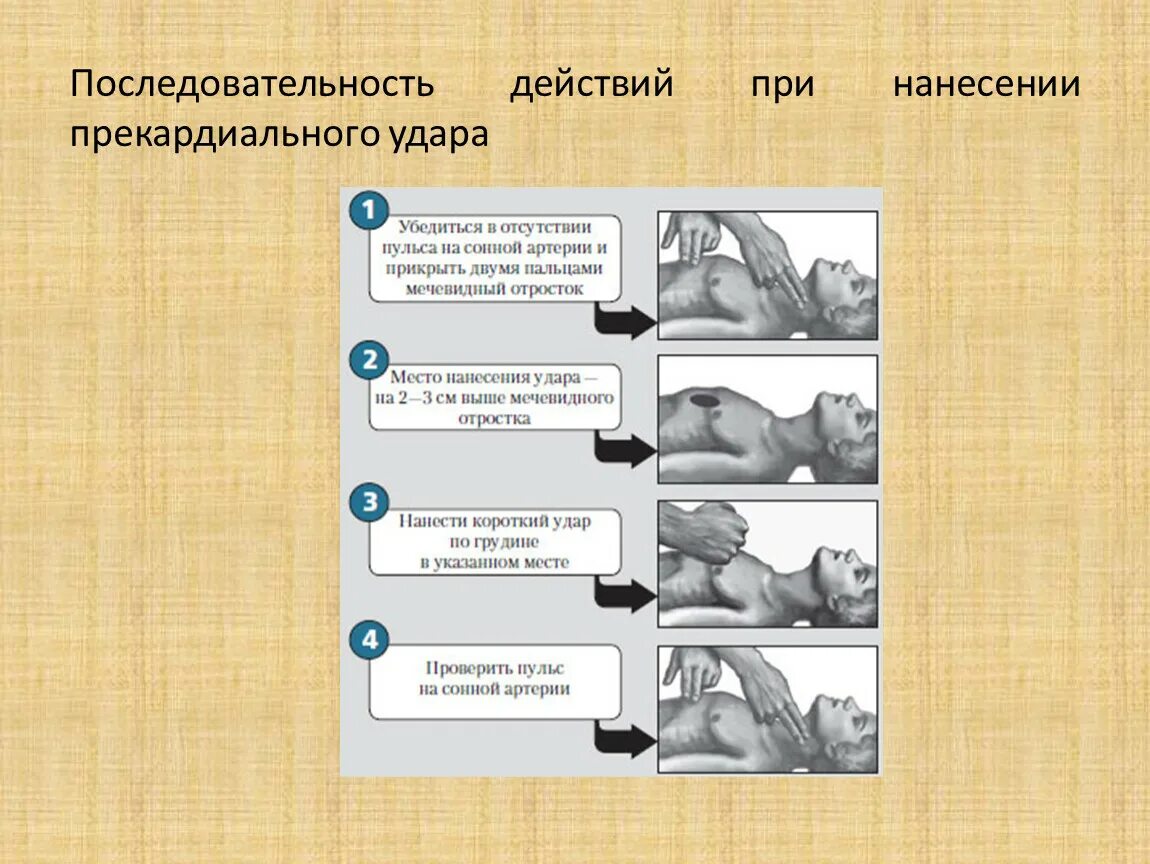 Наносят ли удары сегодня. Порядок нанесения прекардиального удара. Порядок действий при нанесении прекардиального удара. Прекардиальный удар последовательность действия. Последовательность действий.