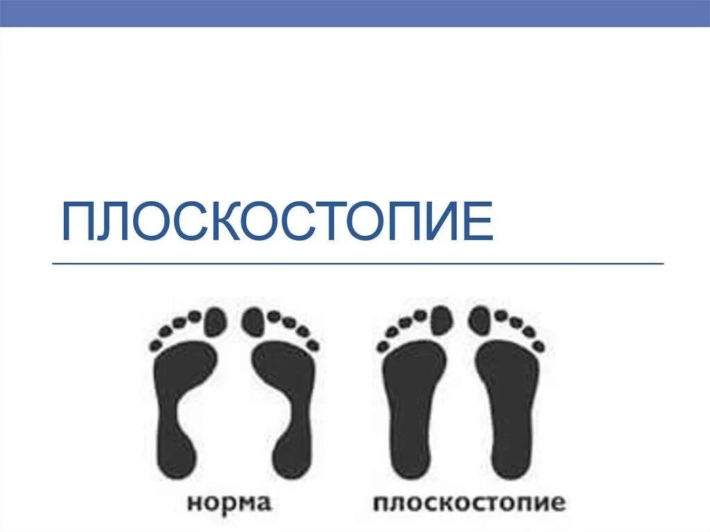 Плоскостопие может быть предотвращено. Плоскостопие. плоскостопие норма. плоскостопие анатомия. нормальная стопа и плоскостопие.