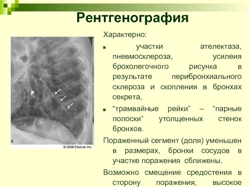 Пневмосклероз легких прогноз. Пневмосклероз рентген. сегментарный ателектаз рентген. пневмосклероз симптомы.