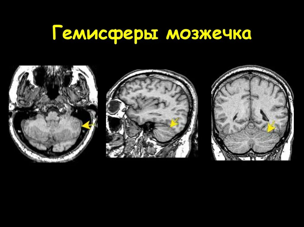 Гипоплазия червя. Кт новообразование мозжечка. Мальформация мозжечка мрт. Венозная ангиома мозжечка мрт. Гипоплазия гемисферы мозжечка.