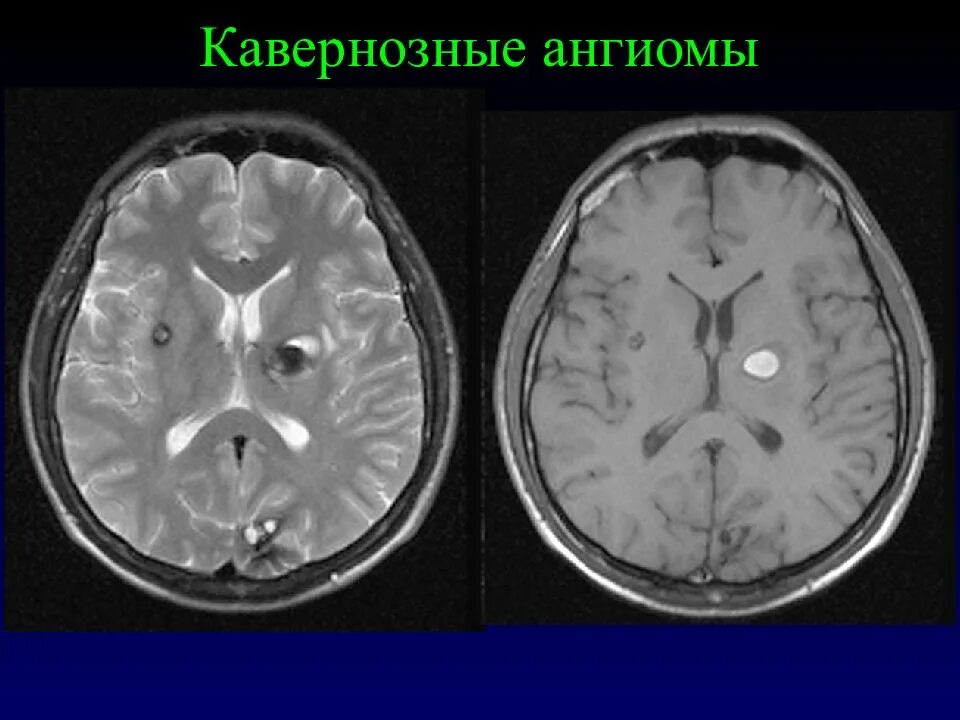 Ангиома правой лобной доли. Кавернозная ангиома головного мозга мрт. Кавернозная ангиома головного мозга кт. Венозная ангиома головного мозга кт. Кавернозная гемангиома головного мозга кт.