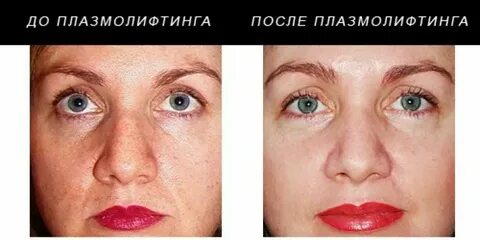 Холодная плазма сколько процедур нужно