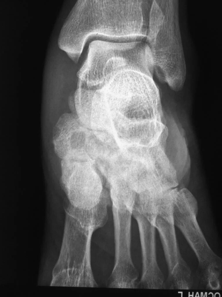 келлер 1 и остеохондропатия. асептический некроз костей стопы. таранная кость асептический некроз. остеохондропатия келер 2. асептический некроз сесамовидной кости стопы.