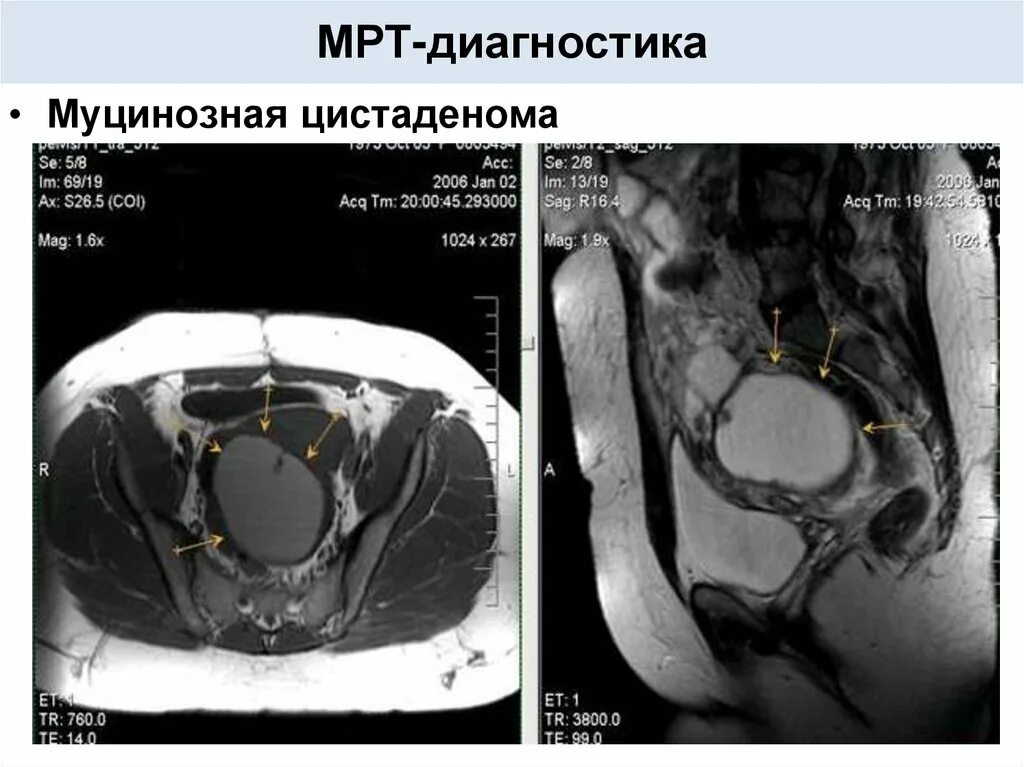 Рак яичника мрт. Муцинозная опухоль яичника мрт. Муцинозная киста яичника мрт. Муцинозная цистаденома яичника мрт. Объемное образование яичника мрт.