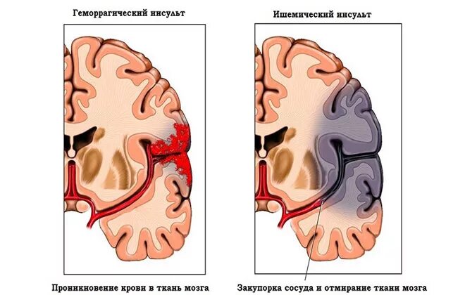 Кровоизлияние в мозг у новорожденного степени. Кровоизлияние 3 степени головного мозга. кровоизлияние в мозг степени. кровоизлияние головного мозга у новорожденных.