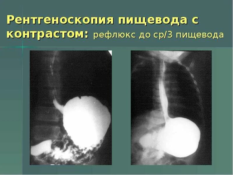 Рефлюкс диафрагмы. Желудочно пищеводный рефлюкс рентген. ГЭРБ рентгенологические признаки. Рефлюкс желудка рентген. Рефлюкс эзофагит рентген.