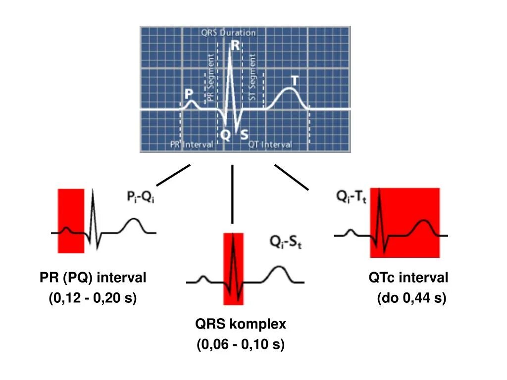 Увеличение интервала pq. Интервал PQ. Интервал QTC. Интервал PQ 220. Короткий интервал PQ на ЭКГ.
