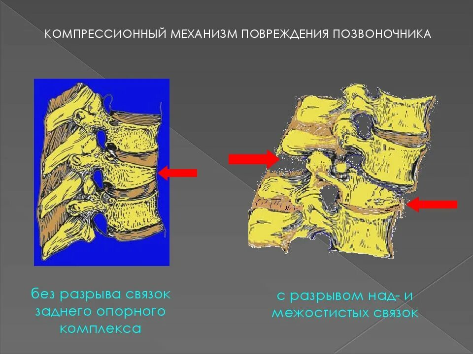 Компрессионные переломы позвонков кт. Компрессионный перелом позвоночника. Компрессионный перелом позвонка кт. Компрессионный перелом 3 позвонка.