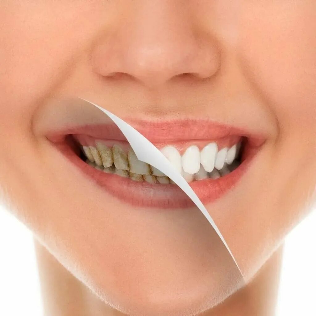 Чистка зубов казань