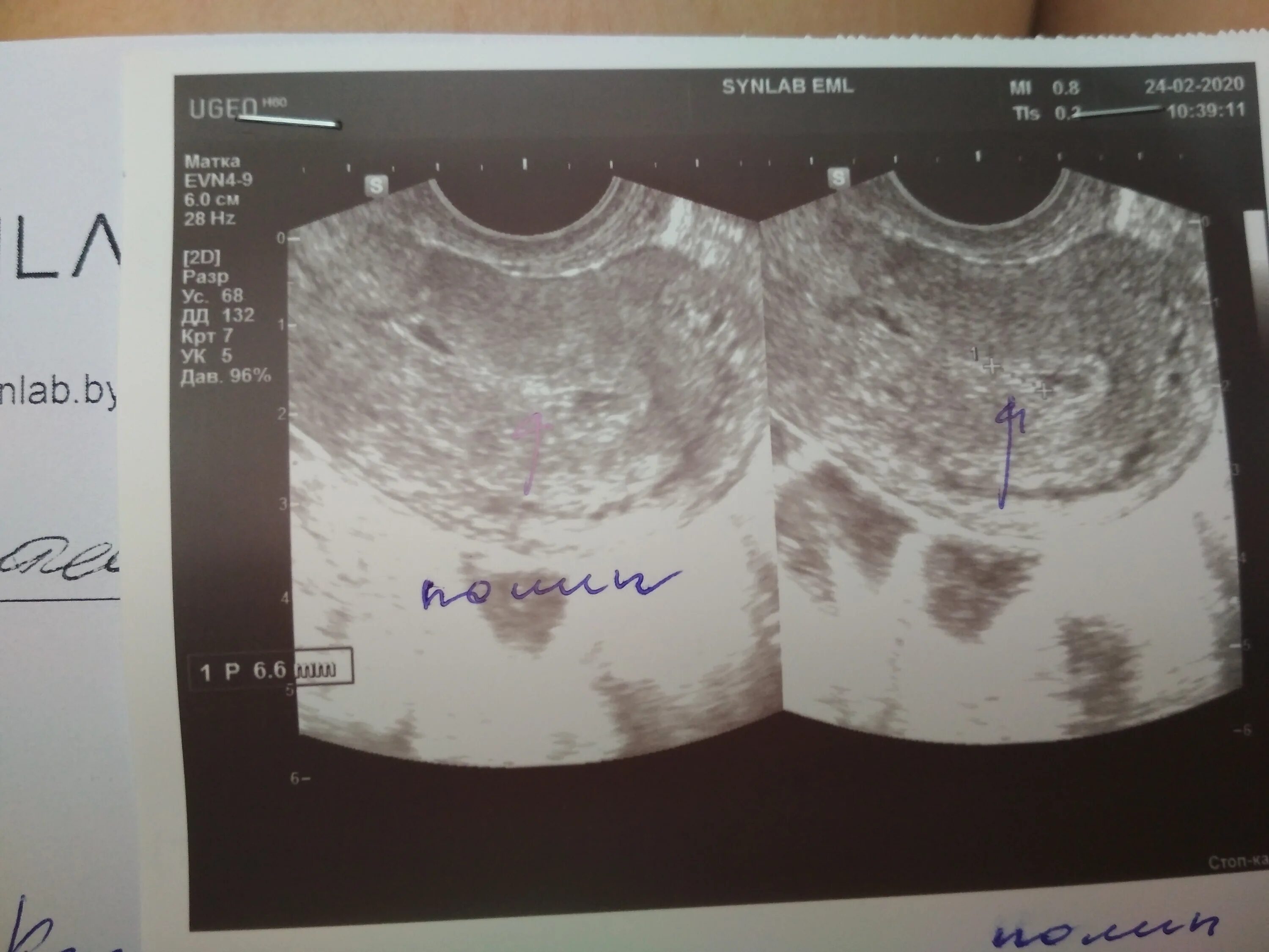 Полип полости матки на УЗИ.