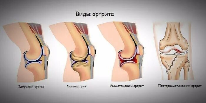 Артрит коленного сустава в домашних условиях. Ревматоидный артрит коленного сустава. Ревматический артрит коленного сустава. Артропатия коленного сустава у ребенка. Артрит и артроз коленного сустава.