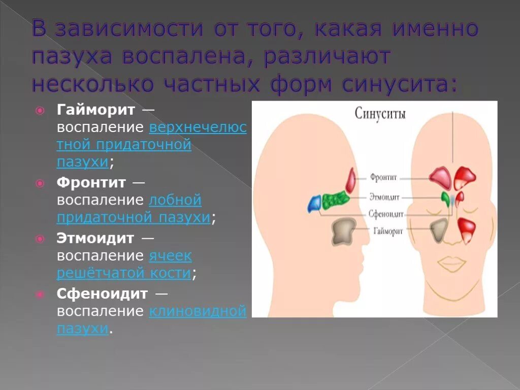 Сфеноидит симптомы.