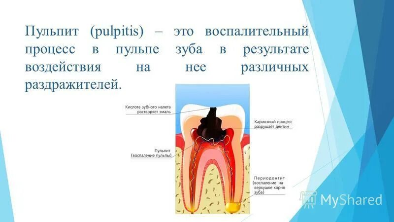 Пульпит симптомы и лечение. Пульпит симптомы и лечение