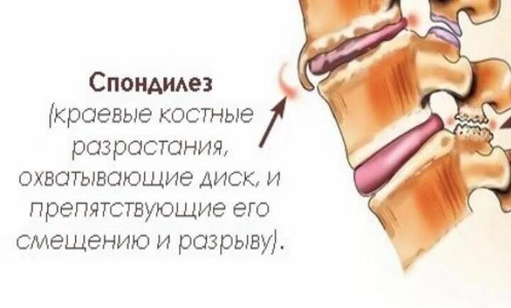 Спондилеза спондилоартроза поясничного отдела позвоночника. Спондилез пояснично-крестцового отдела позвоночника. Спондилез передней продольной связки. Деформирующий спондилоартроз грудного отдела позвоночника. Деформирующий спондилез спондилоартроз.