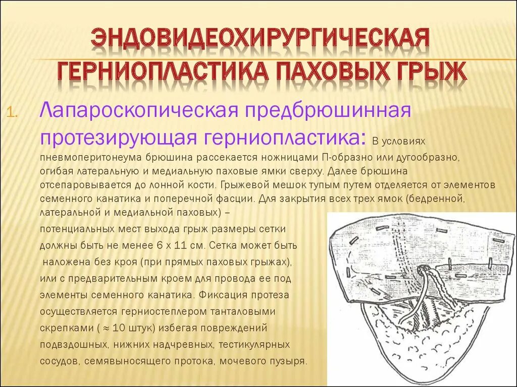 Цена лечения паховых грыж. Эндовидеохирургическая герниопластика. Трансабдоминальная предбрюшинная герниопластика. Лапароскопическая операция грыжесечение. Методики "лапароскопической герниопластики".