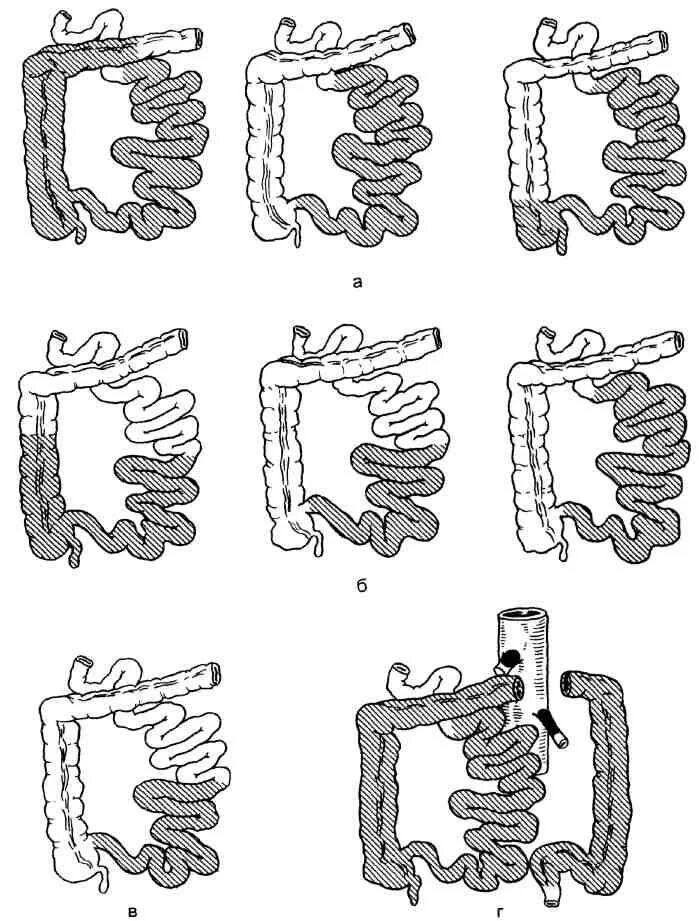 Мезентериальный тромбоз сегменты. Мезентериальный тромбоз кишечника сегменты. Мезентериальный тромбоз верхней брыжеечной. Сегменты верхней брыжеечной артерии. Острое мезентериальное кровообращение