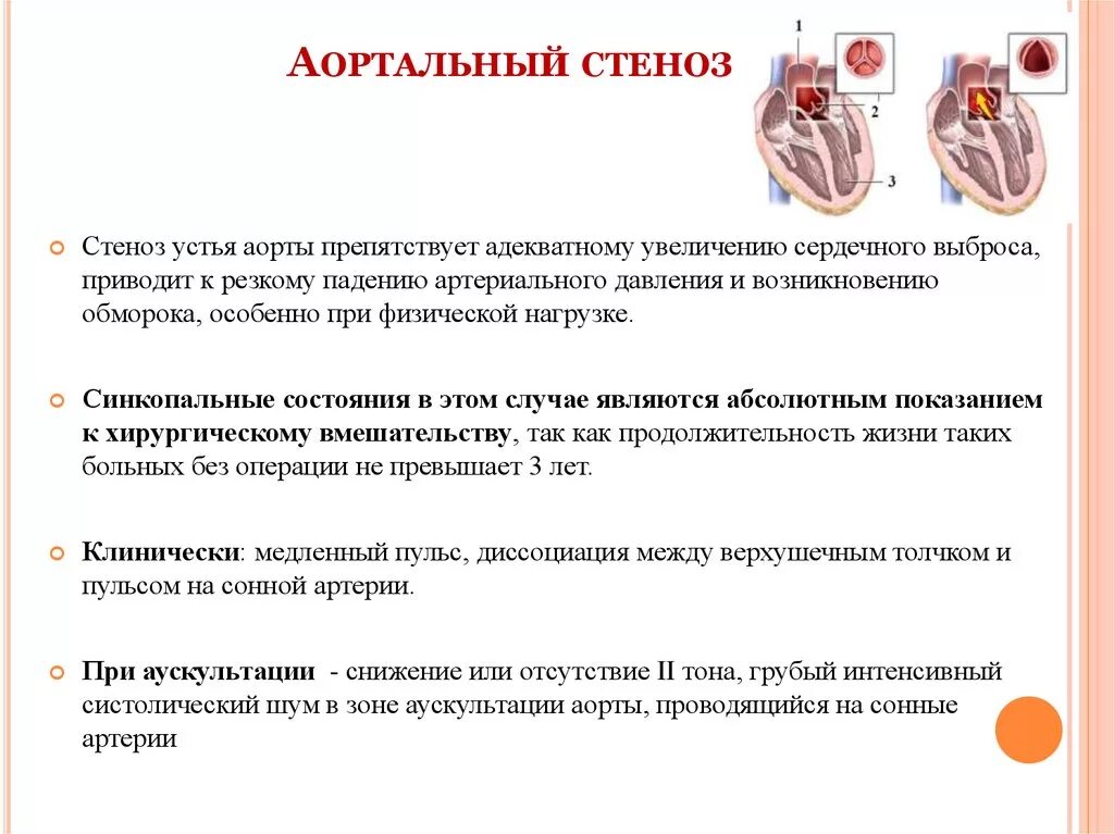 Синдром стеноза. Причины стеноза аортального клапана. Стеноз аортального клапана ад. Клинические проявления стеноза аортального клапана. Причиной приобретённого стеноза аортального клапана является.