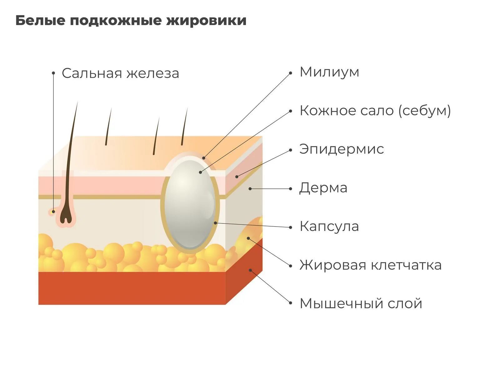 Капсула жировика