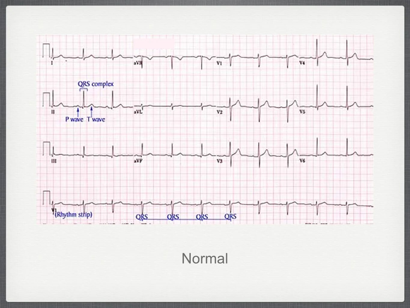 Qrs на экг что это. Комплекс QRS на ЭКГ. Комплекс QRS на ЭКГ норма. Формы комплекса QRS на ЭКГ. Комплекс QRS 0.05.