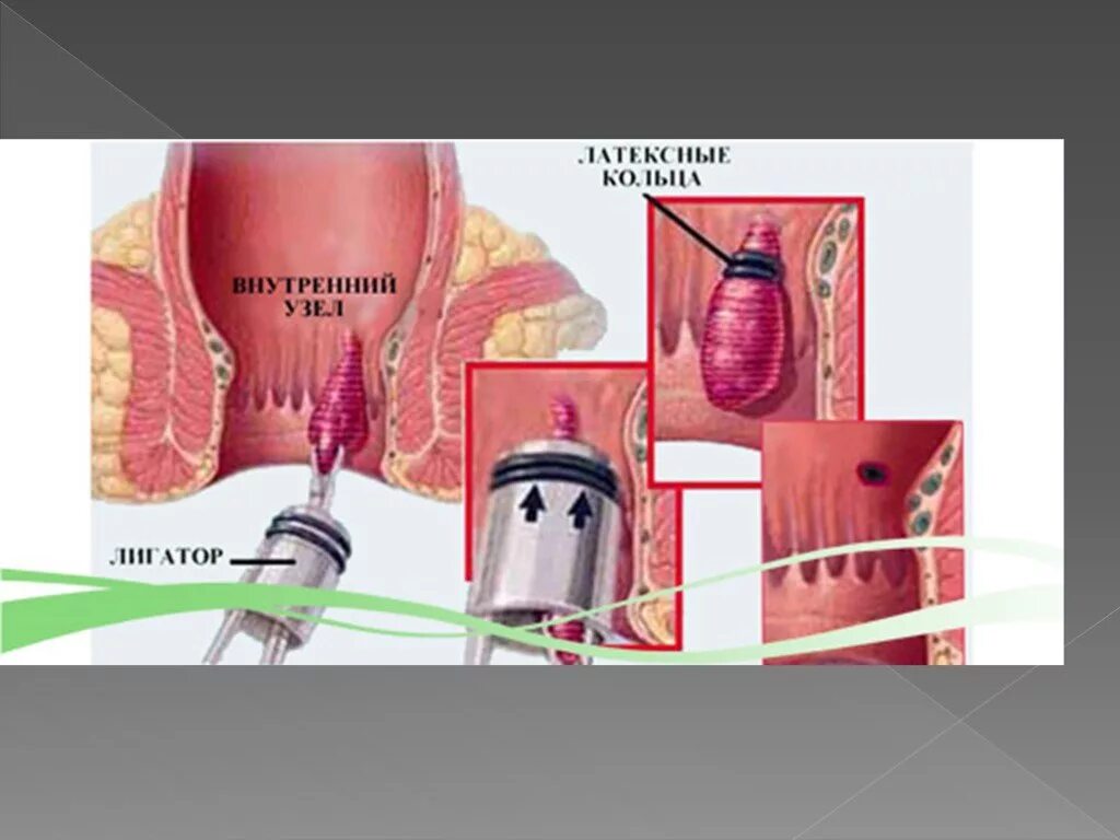 Лигирование внутренних геморроидальных узлов. Малоинвазивное лечение геморроя