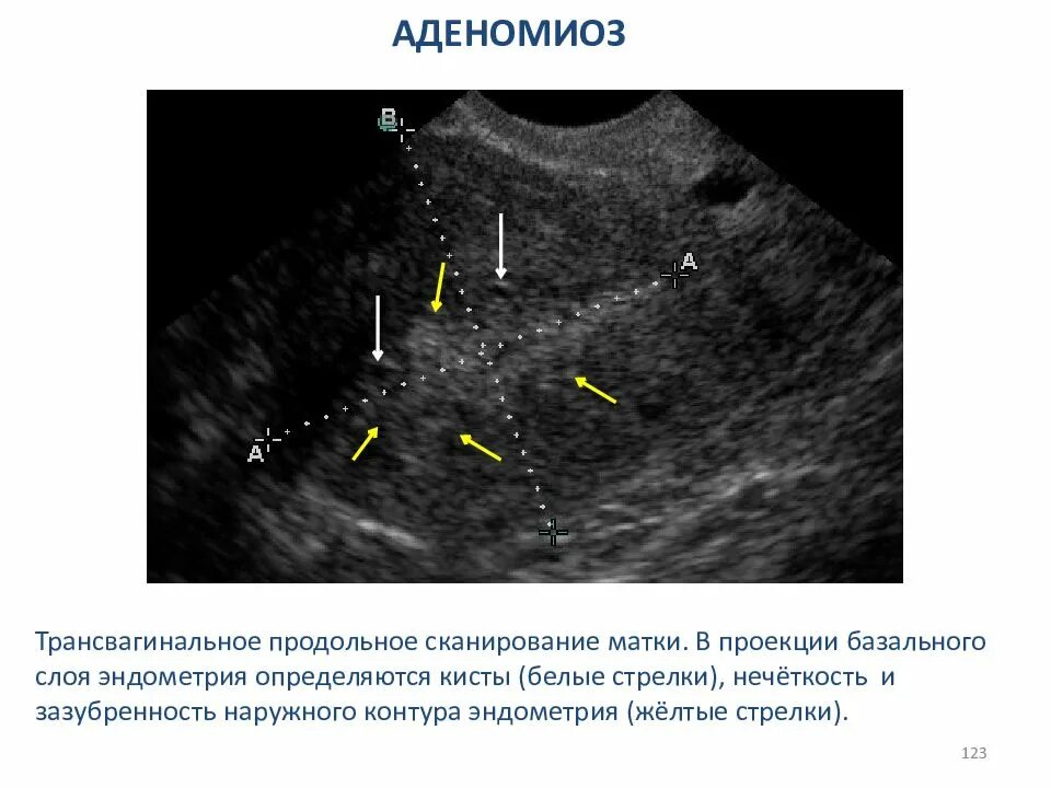 Эхопризнаки аденомиоза что это. УЗИ признаки аденомиоза. УЗИ матки при аденомиозе. Аденомиоз по УЗИ признаки.