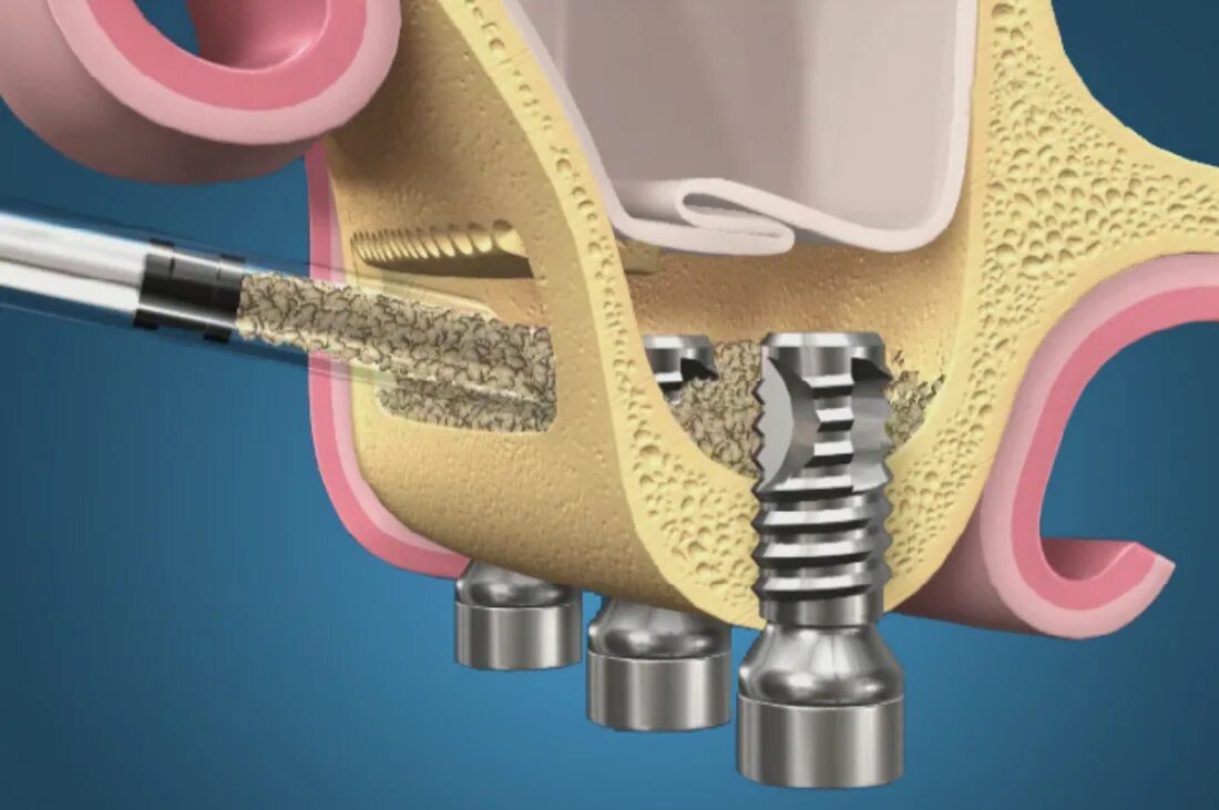 Крестальный синус-лифтинг. Синус-лифтинг (Bio-oss 1 грамм). Синус-лифтинг (костная пластика, остеопластика) открытый. Синус-лифтинг (костная пластика, остеопластика) закрытый. Синус лифтинг в спб