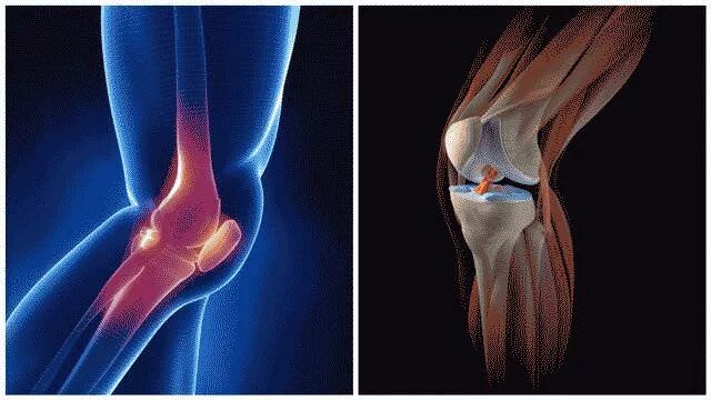Сильные боли при разгибании колена. Болят суставы. Боль в колене.