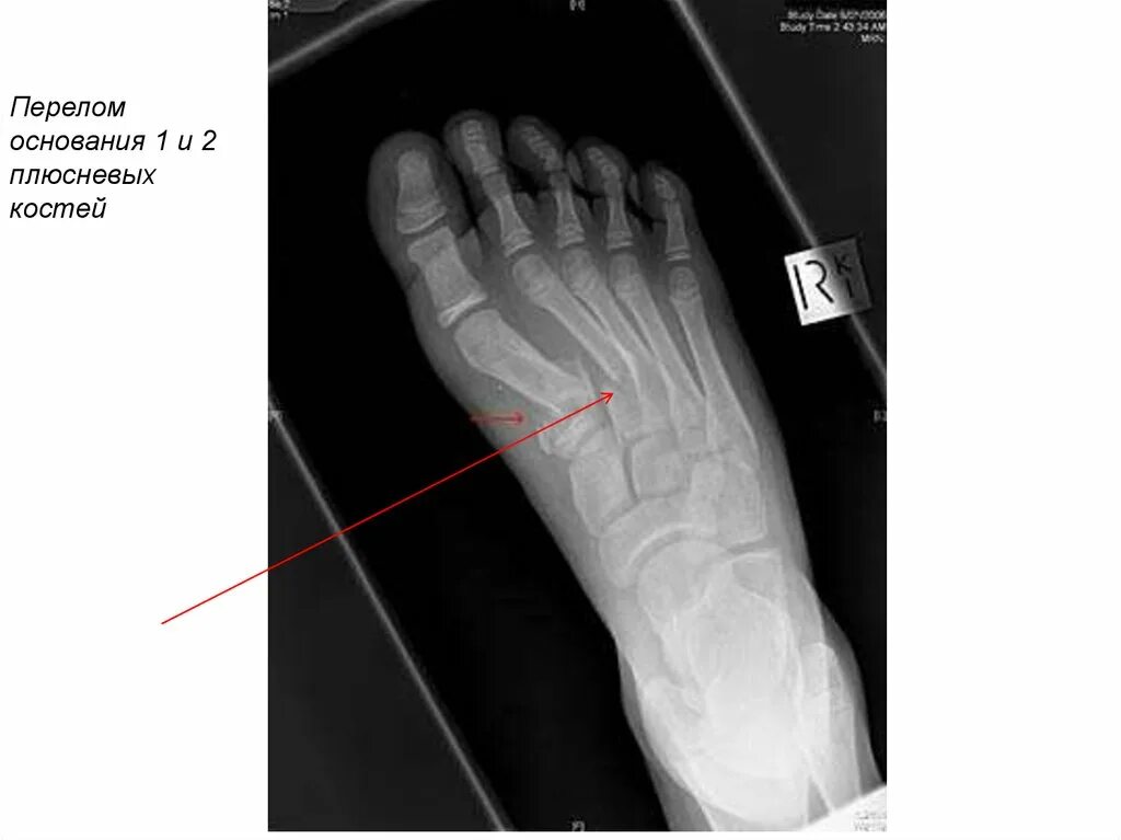 Перелом 5 плюсневой кости Кост. Перелом IV плюсневой кости. Рентген 5 плюсневой кости. Рентген перелом 2 плюсневой кости стопы. Трещина плюсневой