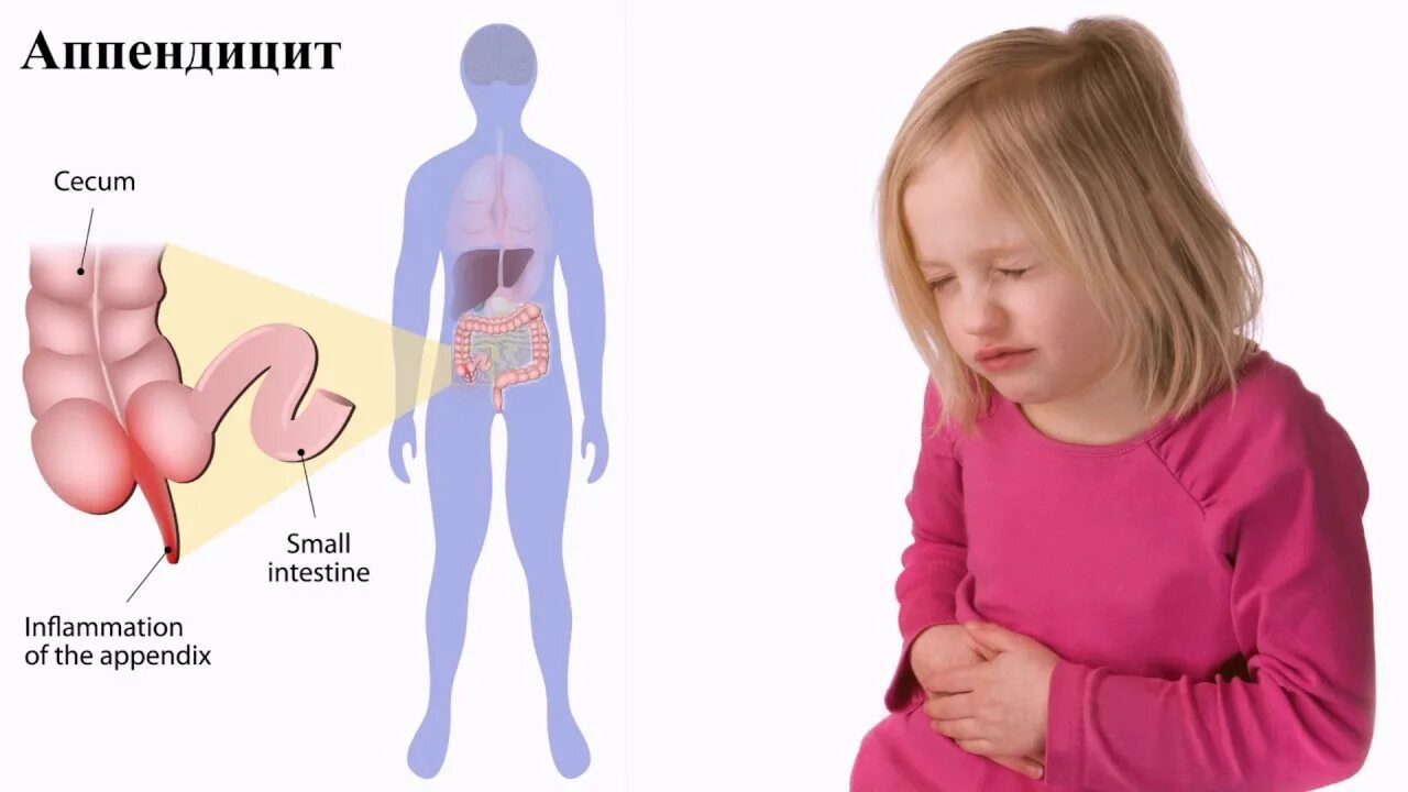 Аппендицит в 3 года. Аппендицит у детей. Аппендицит симптомы у детей 12 лет. Где находится аппендикс у детей.