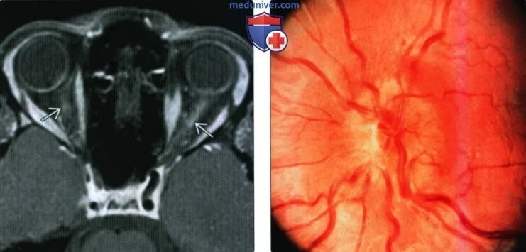 Неврит зрительного нерва мрт. Ретробульбарный неврит зрительного нерва. Неврит зрительного нерва кт. Атрофия зрительного нерва мрт.