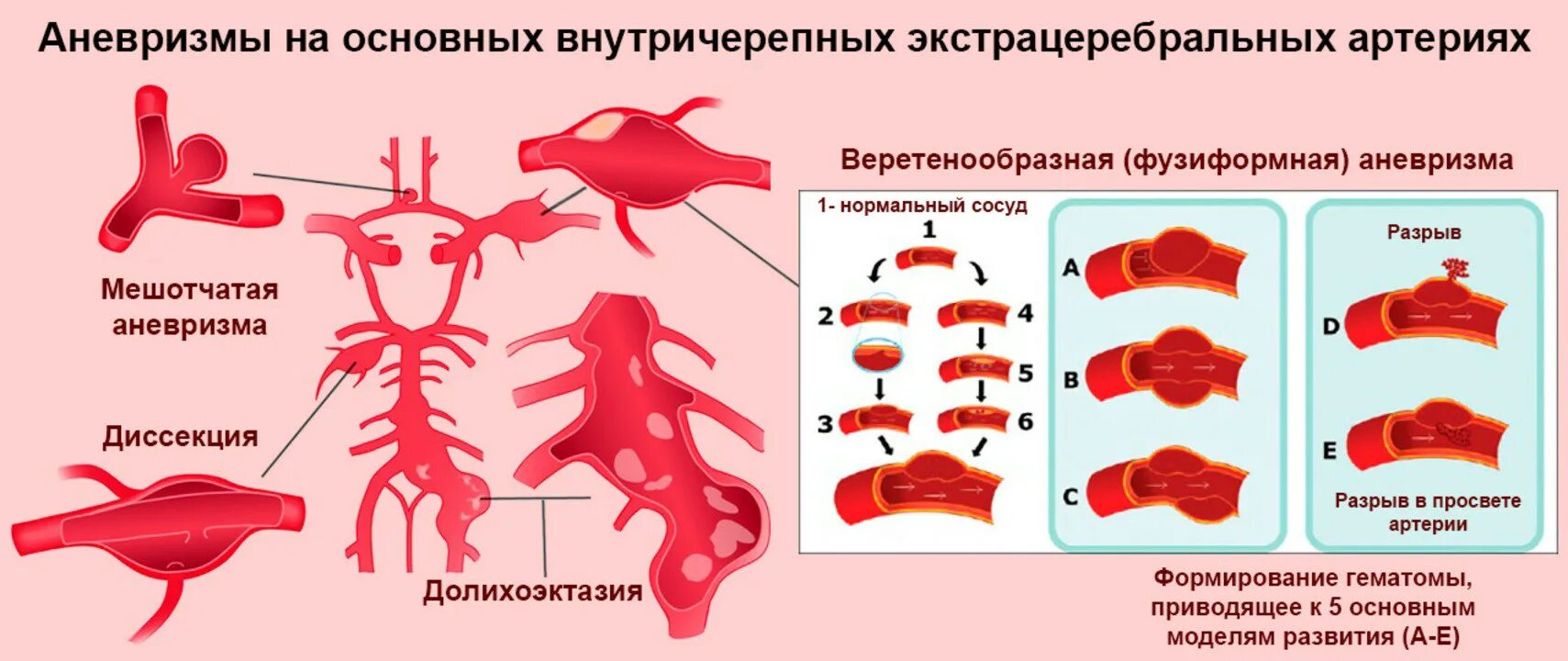 Форум аневризма мозга. Аневризмы сосудов головного мозга классификация. Микроаневризма сосудов головного мозга симптомы. Классификация аневризм по локализации. Ложная аневризма классификация.