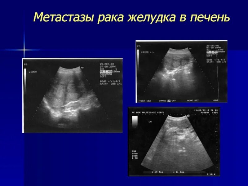 Как выглядит рак печени Liver Cirrhosis Зображення - огляд 15,816 Стокові фото, векторні зображення й ві