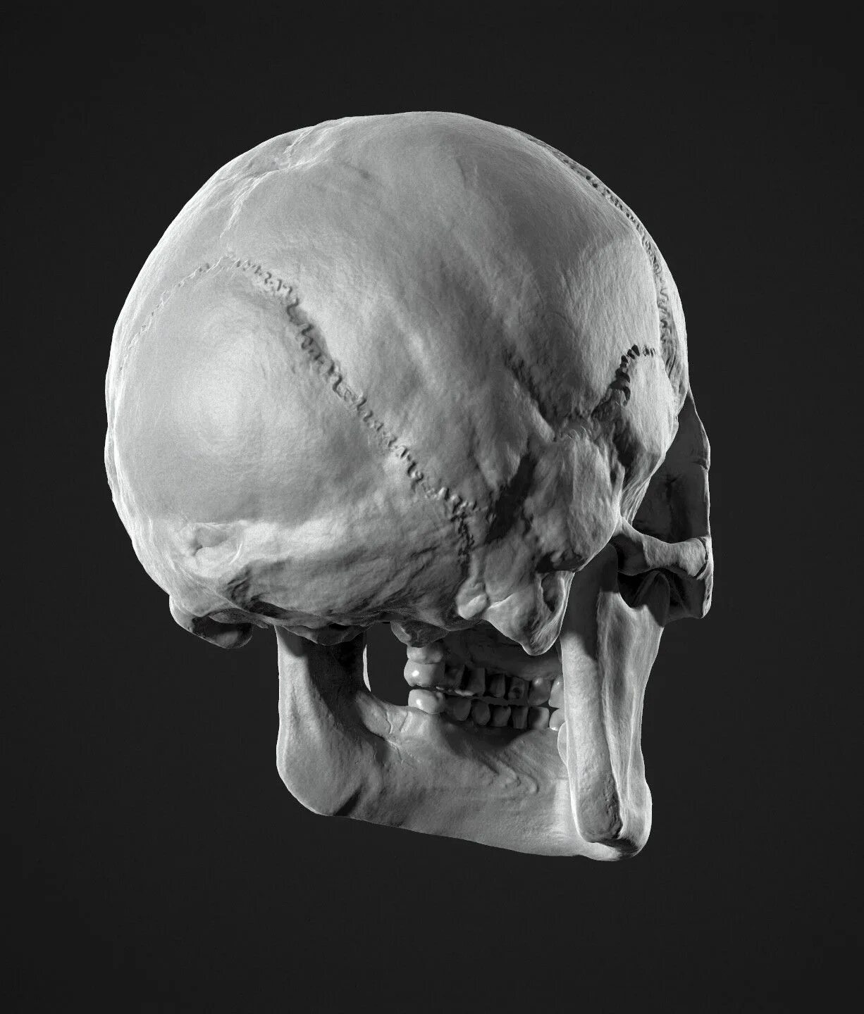 Черепная аномалия. Реальный человеческий череп.